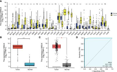 MSLN Correlates With Immune Infiltration and Chemoresistance as a Prognostic Biomarker in Ovarian Cancer